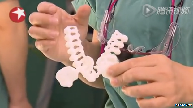 A surgeon holding the 3D-printed model