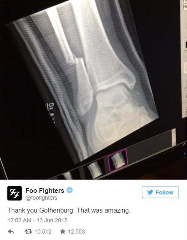 Image of Dave Grohl's leg x-ray