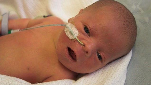 Baby Dexter is pictured resting on a white blanket. A medical tube is inserted into his right nostril and fixed to his cheek with a white plaster