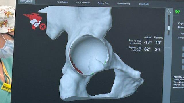 A screen is showing a digital replica of someone's hip. 