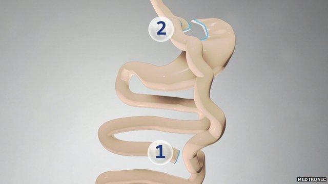 Bariatric surgery image