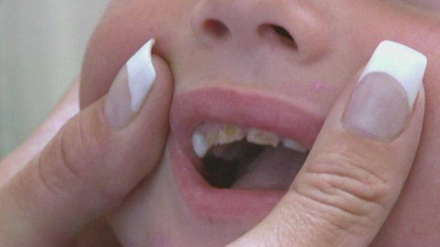 Child with decayed teeth