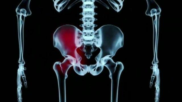 Hip replacement x-ray