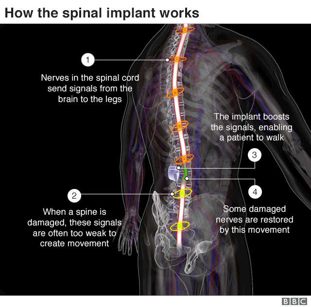 How the spinal implant works