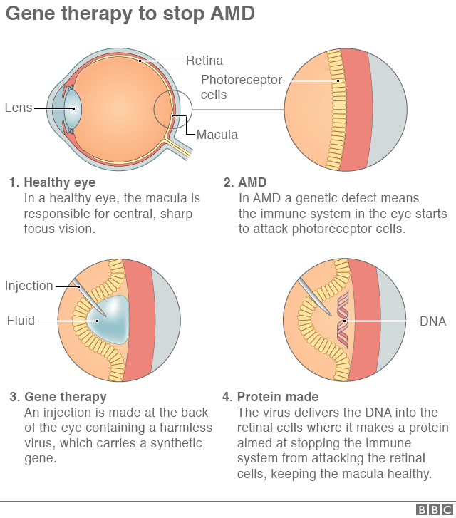 Graphic showing how the gene therapy process works