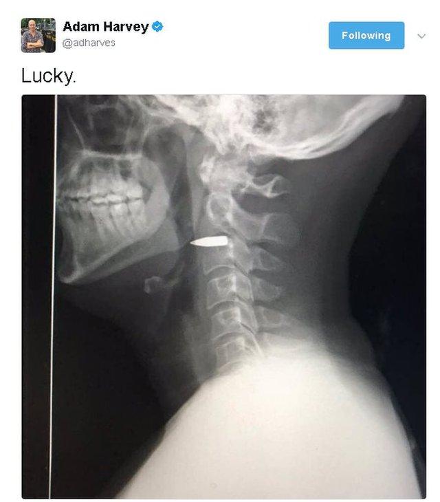 Tweet reads "Lucky" and picture shows an X ray image of a bullet lodged in a neck, between two vertebrae level with the jaw