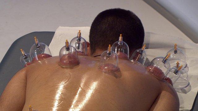 Man undergoing cupping