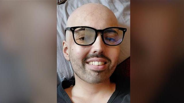Josh wearing a glasses and sporting a bald head during his treatment for a brain tumour
