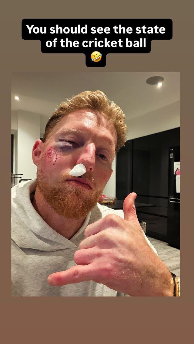 A photo of England Test captain with a black eye and injured nose after being hit by a cricket ball while coaching, with the caption "You should see the state of the cricket ball"