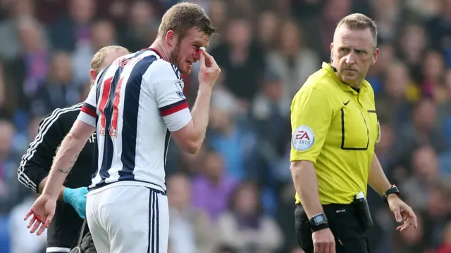 Chris Brunt suffers an injury to his nose