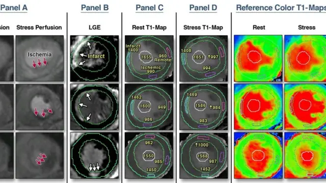 T1-map heart scan