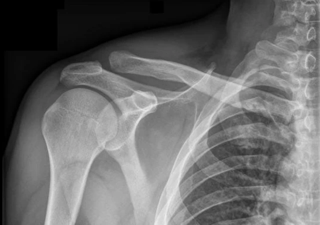 A shoulder x ray