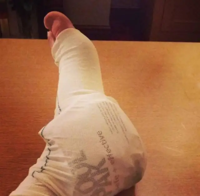 Close up of injured foot bandaged up