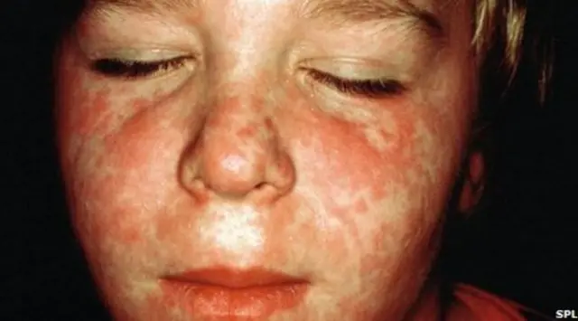 Child with measles