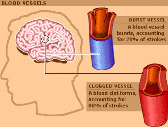 Stroke causes image