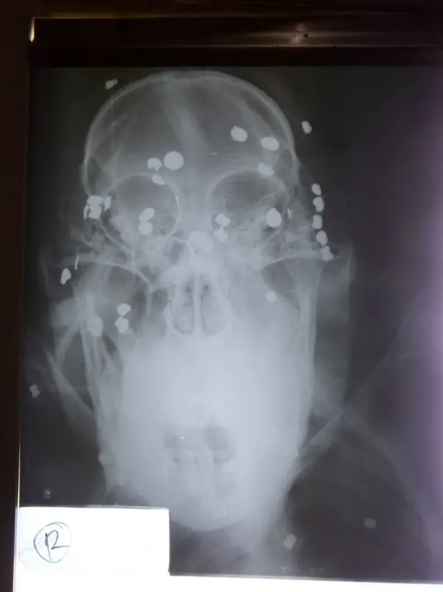 X-ray of Orangutan head