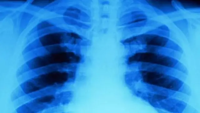 Mesothelioma is a form of cancer that can take decades to develop