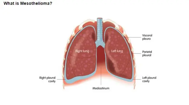 Mesothelioma UK