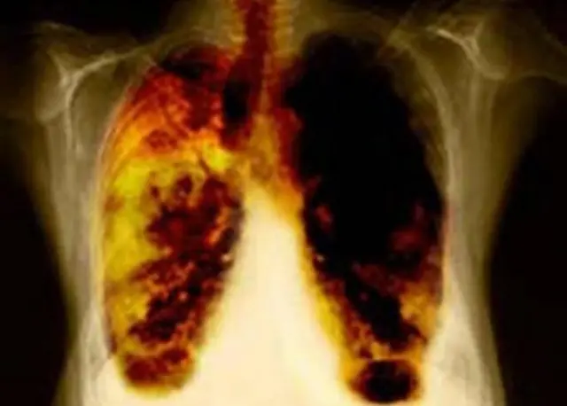 The incidence of lung conditions in Scotland is blamed on historic smoking rates and heavy industry