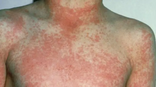 Scarlet fever rash