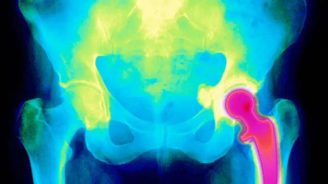 Coloured X-ray of an artificial hip joint