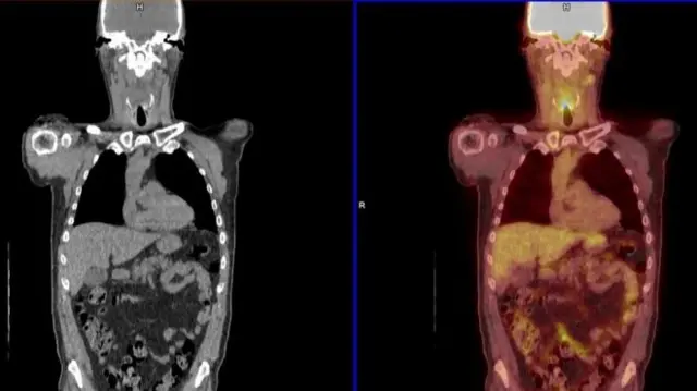 The colour image shows cancer hotspots, including one in the throat