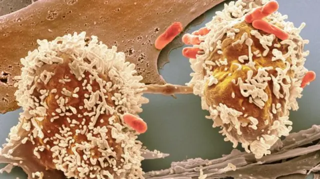 Bowel cancer cells