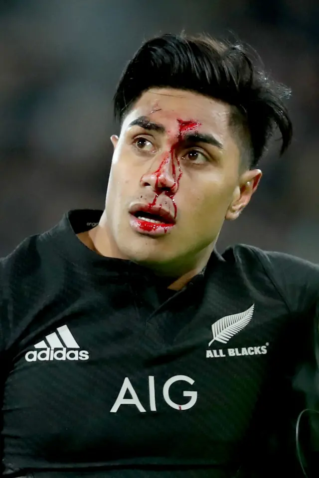 Fekitoa injury