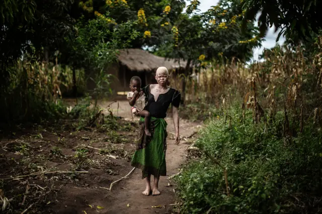 Albino woman in Malawi