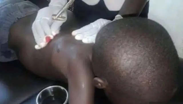 The five-year-old boy having a bullet removed at hospital in Kisumu, Kenya