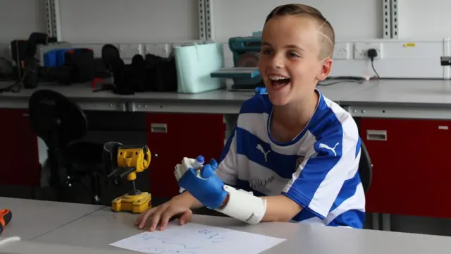 Eight-year-old William with his new plastic hand