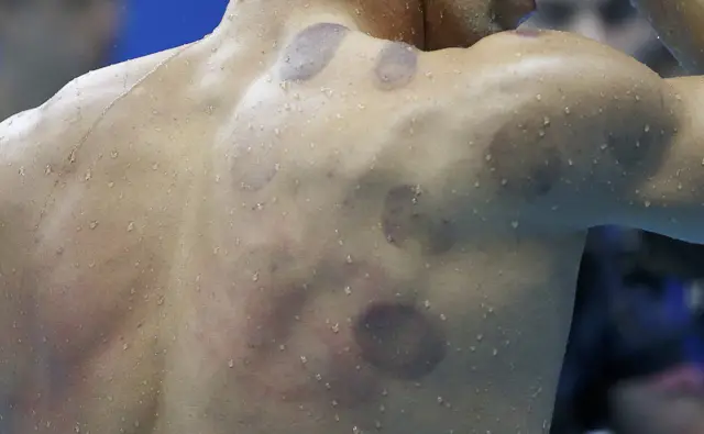 Cupping