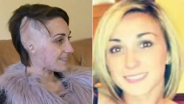 Adele Bellis after and before attack