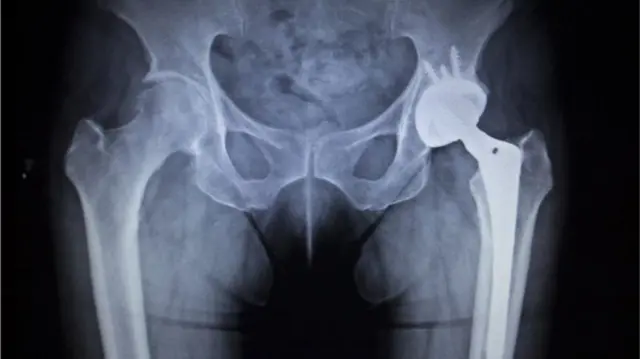 Hip X-ray