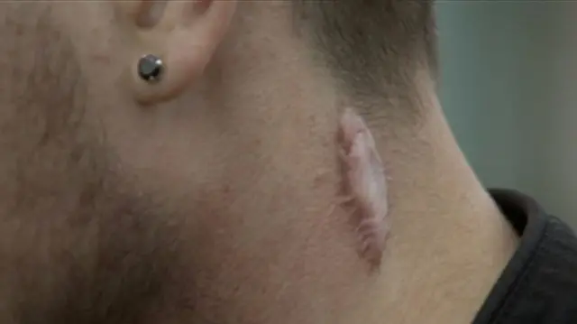 Stab wound to Bartek Milewski's neck