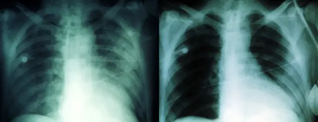 Chest X-ray of a patient with a progressive plague infection (cloudy areas) affecting both lun