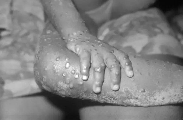 In this 1971 Center For Disease Control handout photo, monkeypox-like lesions are shown on the arm and leg of a female child in Bondua, Liberia