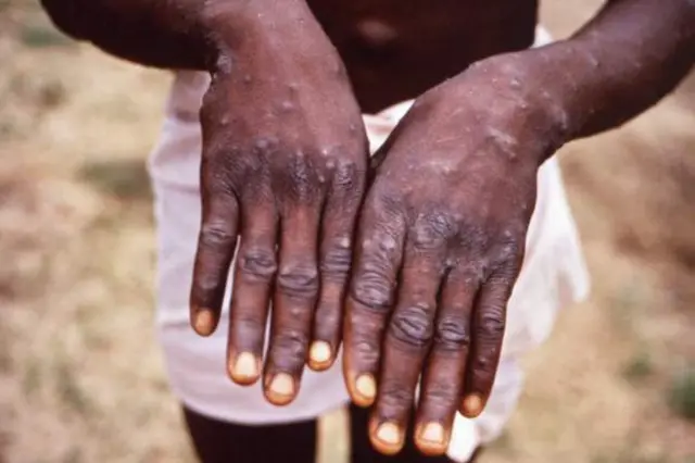 A man with Monkeypox shows his hands