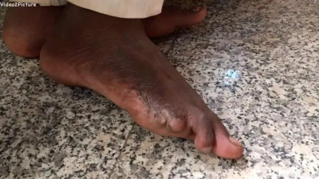 A close up of Hafsat's son's foot showing missing toes