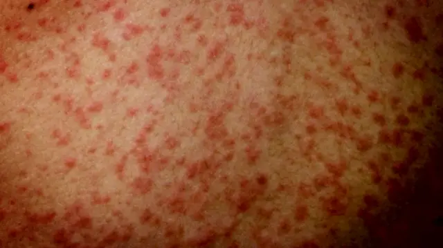 Measles rash