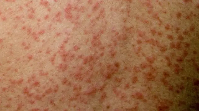 Measles spots