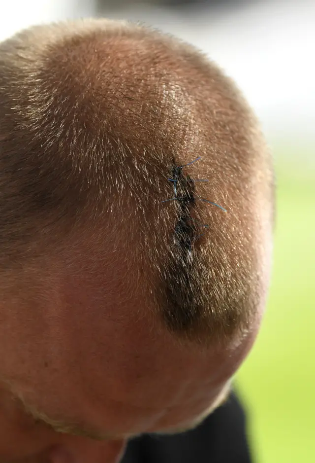 Fletcher's head injury and stitches