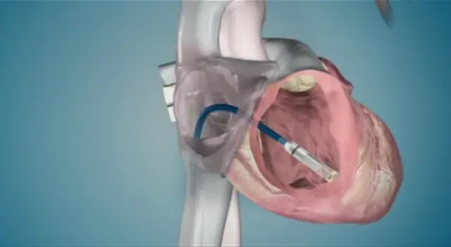 Pacemaker
