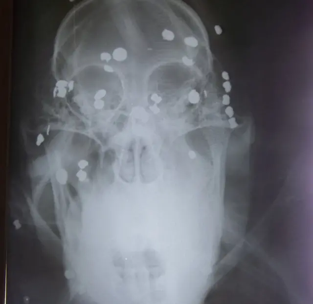 X-ray of Aan, the orangutan