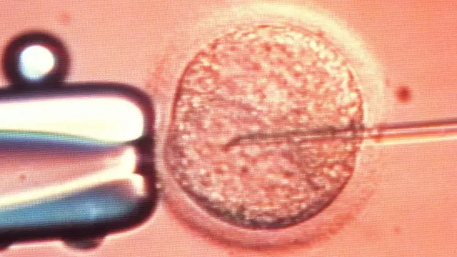 Microscope view of the process of in vitro fertilisation (IVF), in which a human egg (ovum) is being injected with sperm