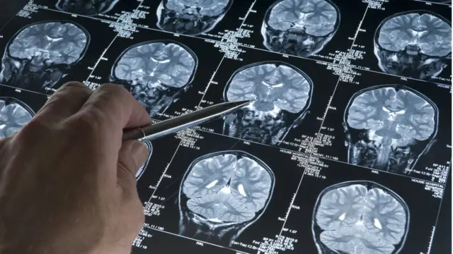 Dementia brain scans