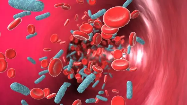 Sepsis