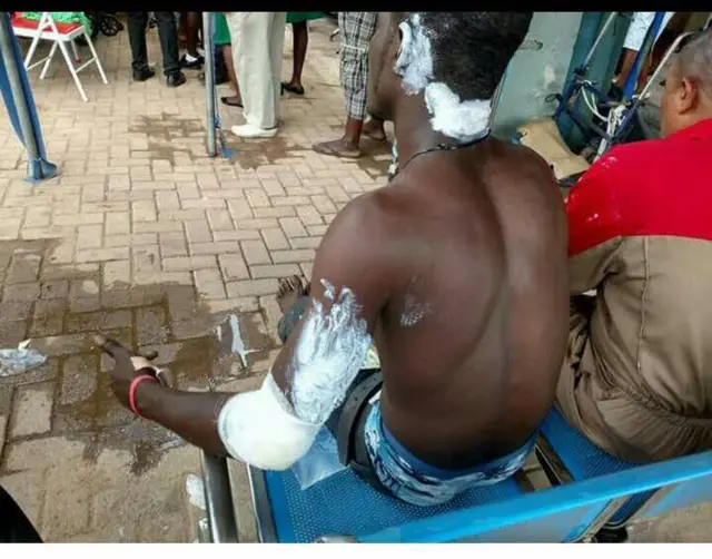 Man receives treatment for burns