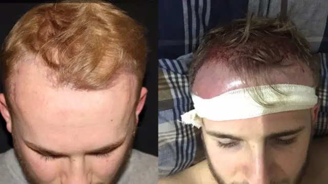 Owen Bigwood before and after hair transplant procedure.