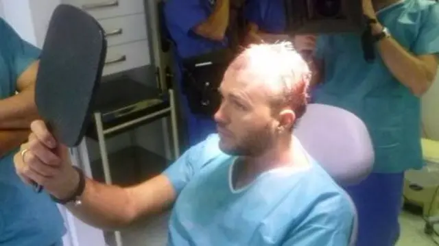 Owen Bigwood after hair transplant procedure.